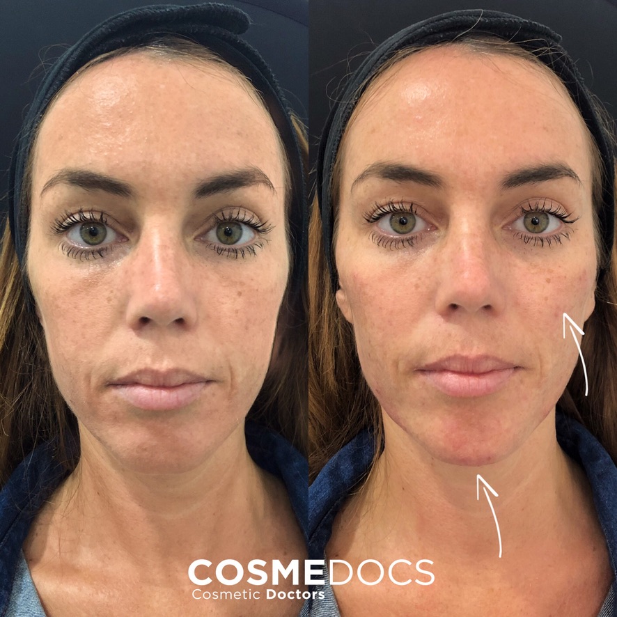 Advanced dermal filler results achieved during Fellowship in Aesthetic Medicine training at Harley Street Institute