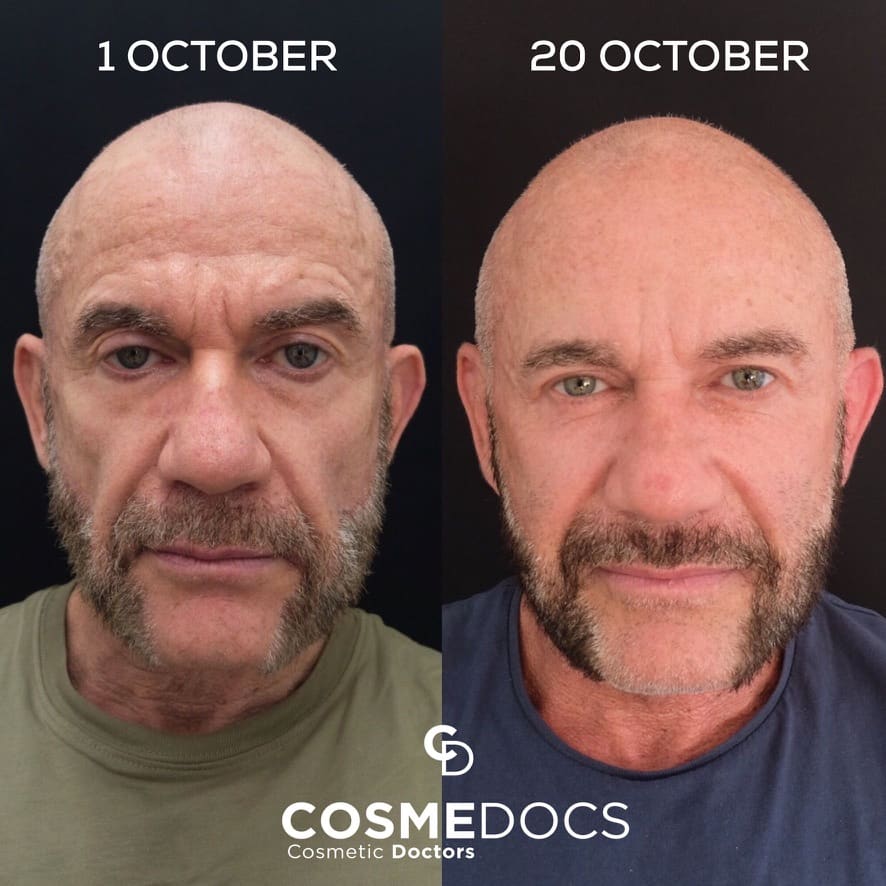 Before and after photos demonstrating heavy makeover transformation with dermal fillers for comprehensive facial rejuvenation