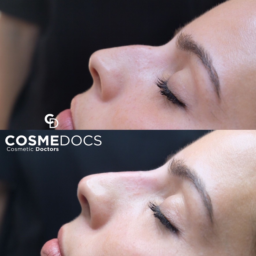 Advanced facial contouring and rhinoplasty results from Fellowship in Aesthetic Medicine at Harley Street Institute