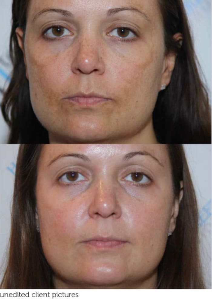 Melasma Treatment Results - Dr Ahmed Haq Client with melasma before and after treatment showing improved skin tone and reduced pigmentation with vitamin C retinol and fusion peels
