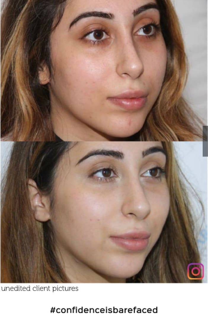 Skin Treatment Results - Dr Ahmed Haq Client before and after skin treatment showing improved texture and tone with vitamin C retinol and chemical peels