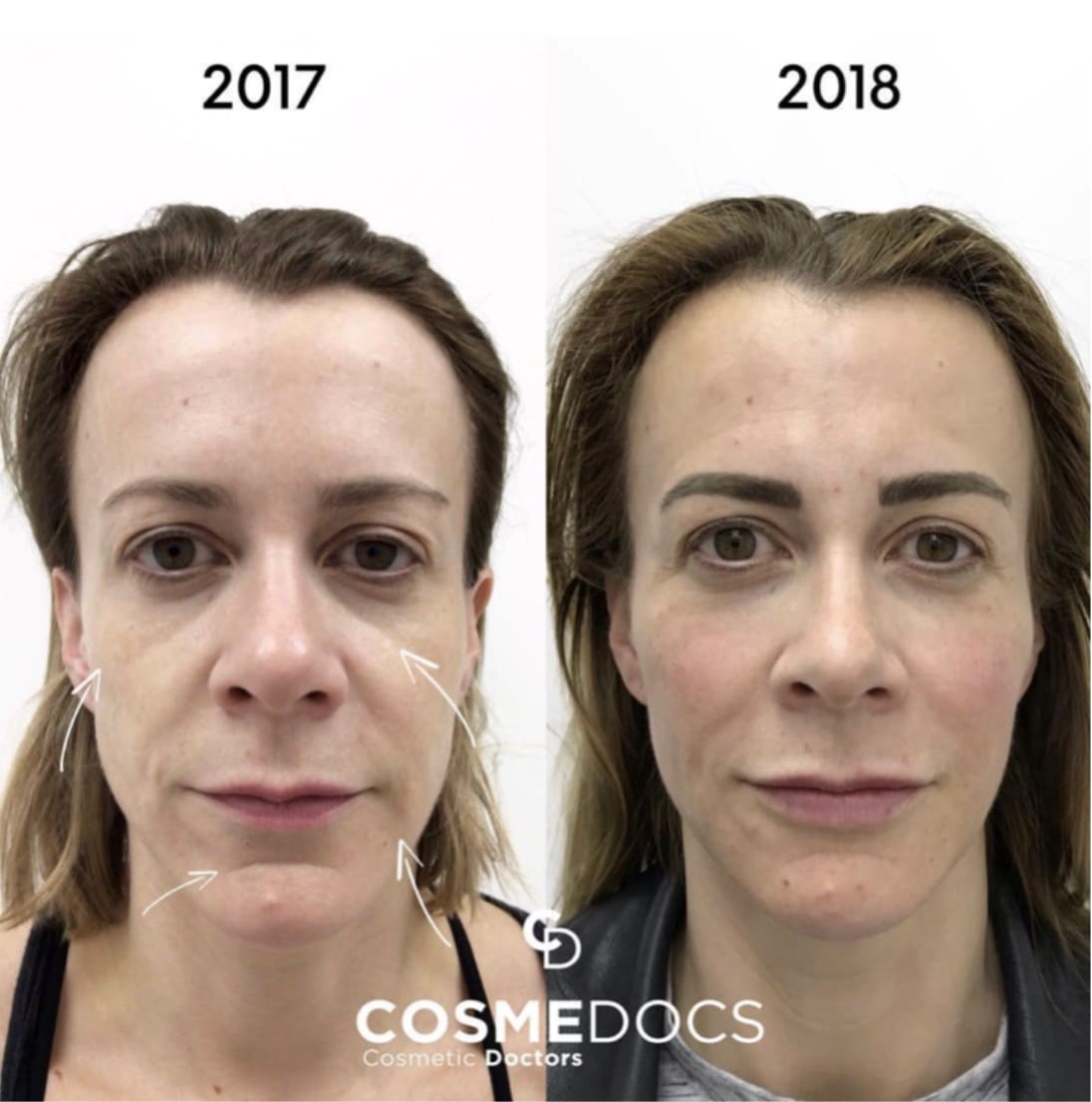 Before and after facial assessment photographs of the same patient one year apart, used to demonstrate scoring with the HSI Mini Facial Scale