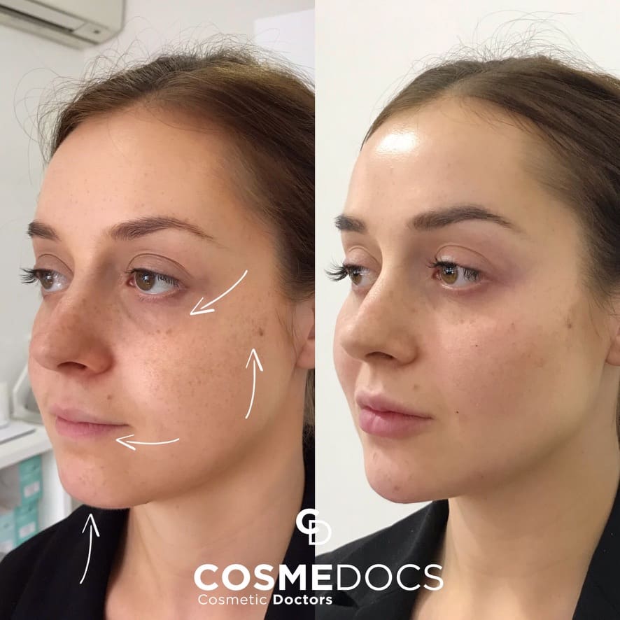 Resultado antes e depois de preenchimento facial e harmonização realizado por aluno do curso de medicina estética