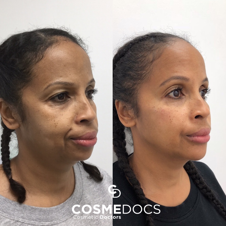 Professional facial rejuvenation results from Harley Street Institute Fellowship in Aesthetic Medicine showing before and after treatment