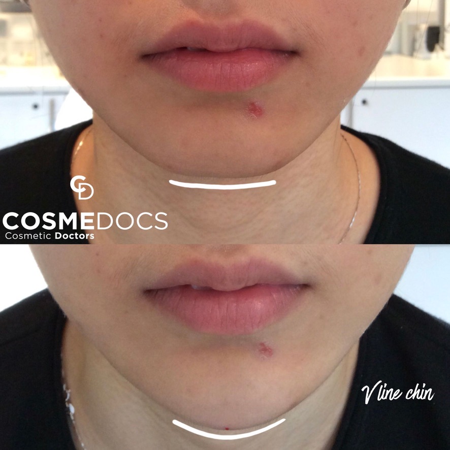 Neck and jawline aesthetic treatment results from Fellowship in Aesthetic Medicine course showing professional technique outcomes