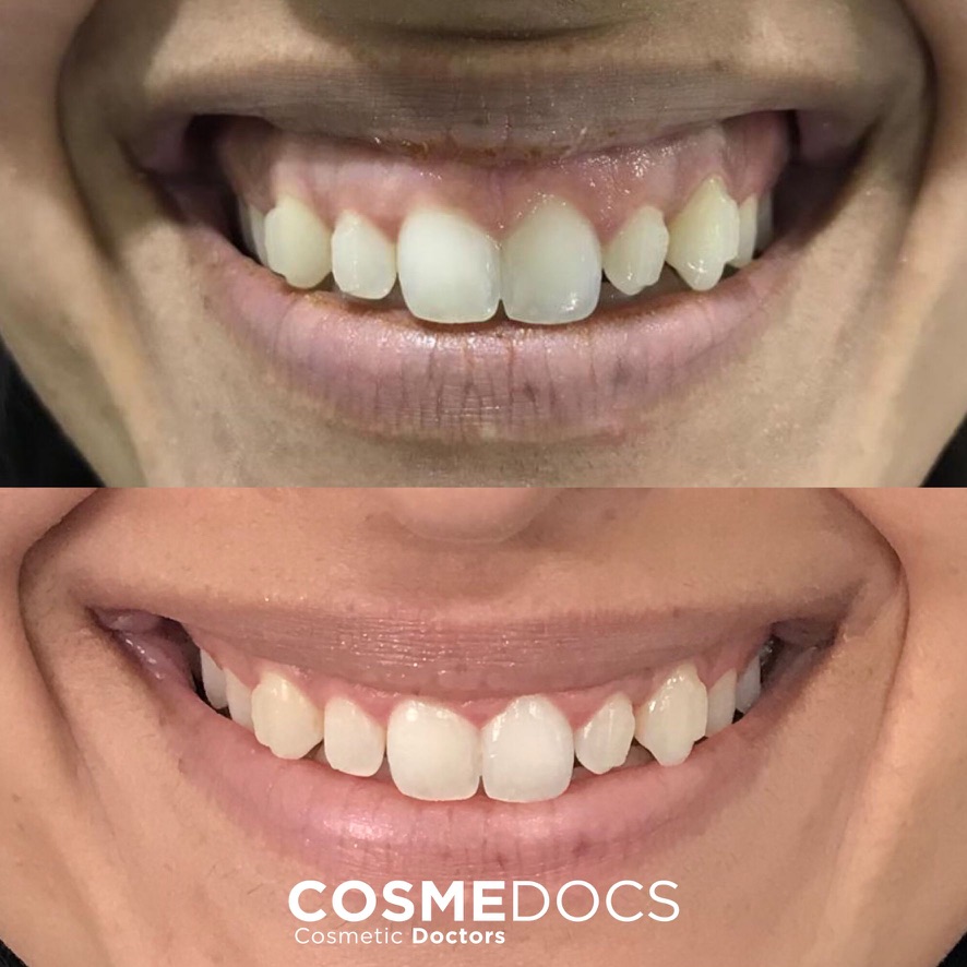 Advanced teeth and smile aesthetic results from Harley Street Institute Fellowship programme