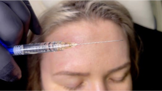 Forehead Indentations Treatment With Dermal Fillers - Advanced Training for aesthetic medicine practitioners