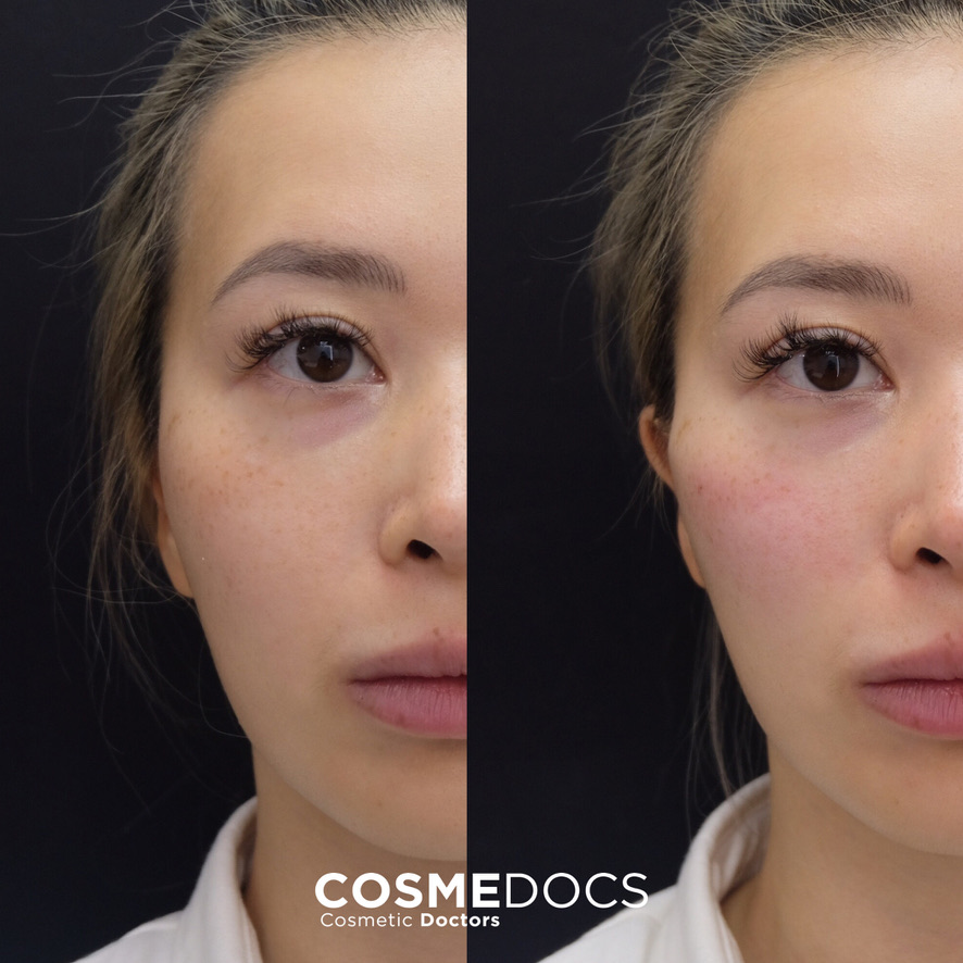 Masseter botox before and after results showing jaw slimming and facial contouring outcome