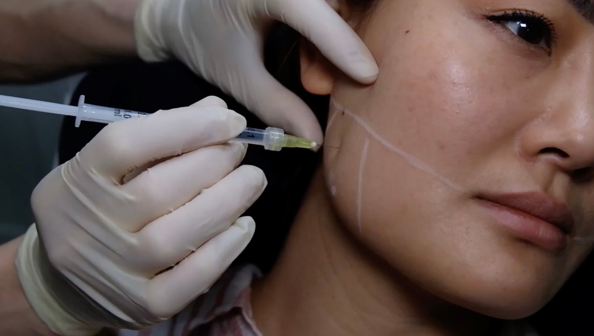 Online: Masseter Botox for Bruxism & Jaw Slimming