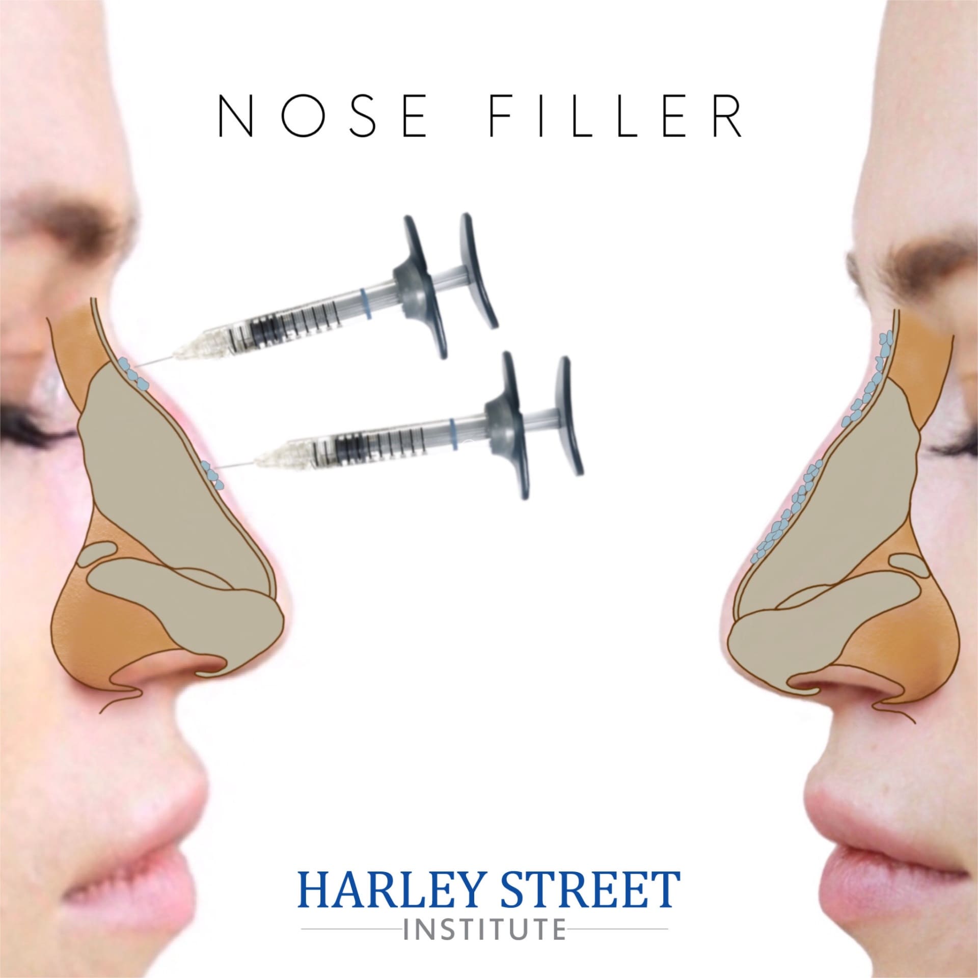 Simple soft tissue augmentation (skin and subcutaneous) Nose filler injection diagram showing simple soft tissue augmentation