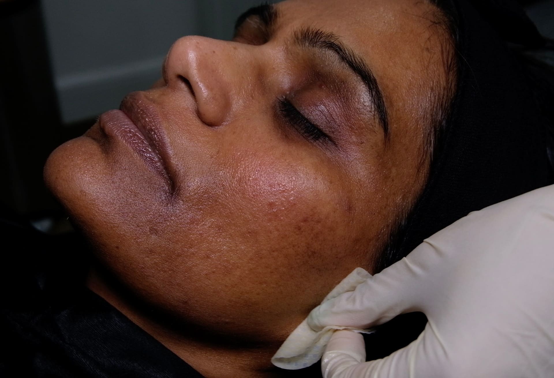 PIH Management After Microneedling - Dr Ahmed Haq Managing post-inflammatory hyperpigmentation following deep microneedling treatment in deviated skin types