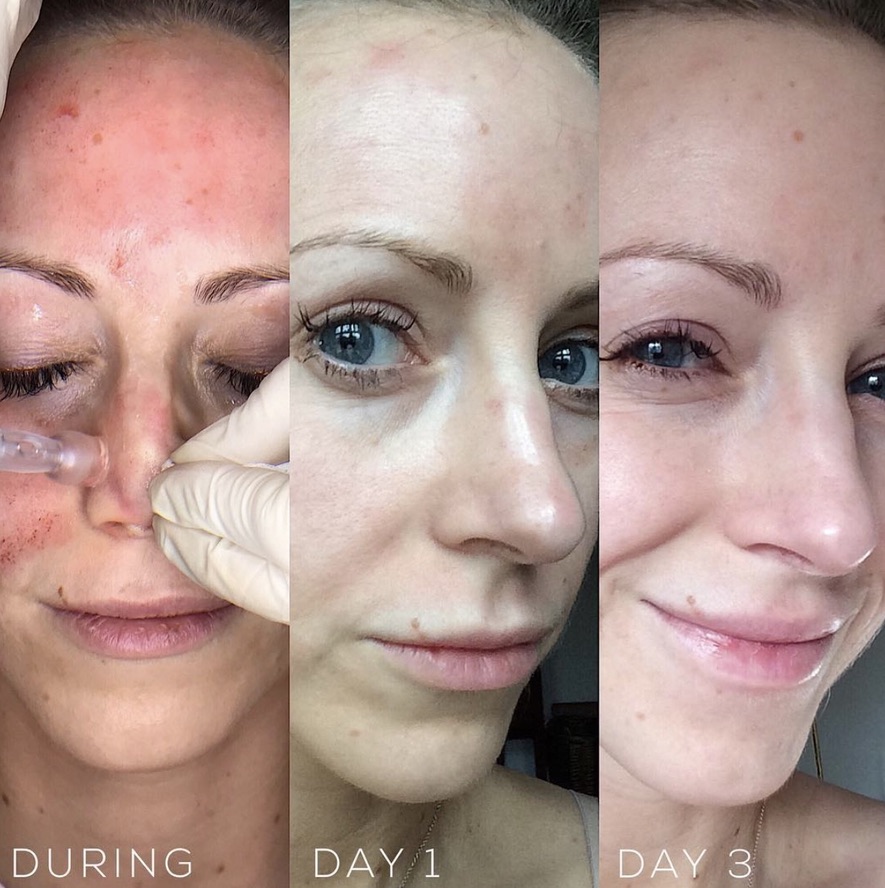 Microneedling treatment during and recovery results