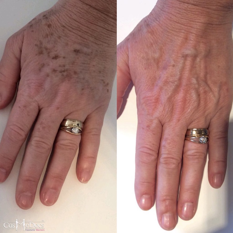 Hand rejuvenation treatment results with chemical peels