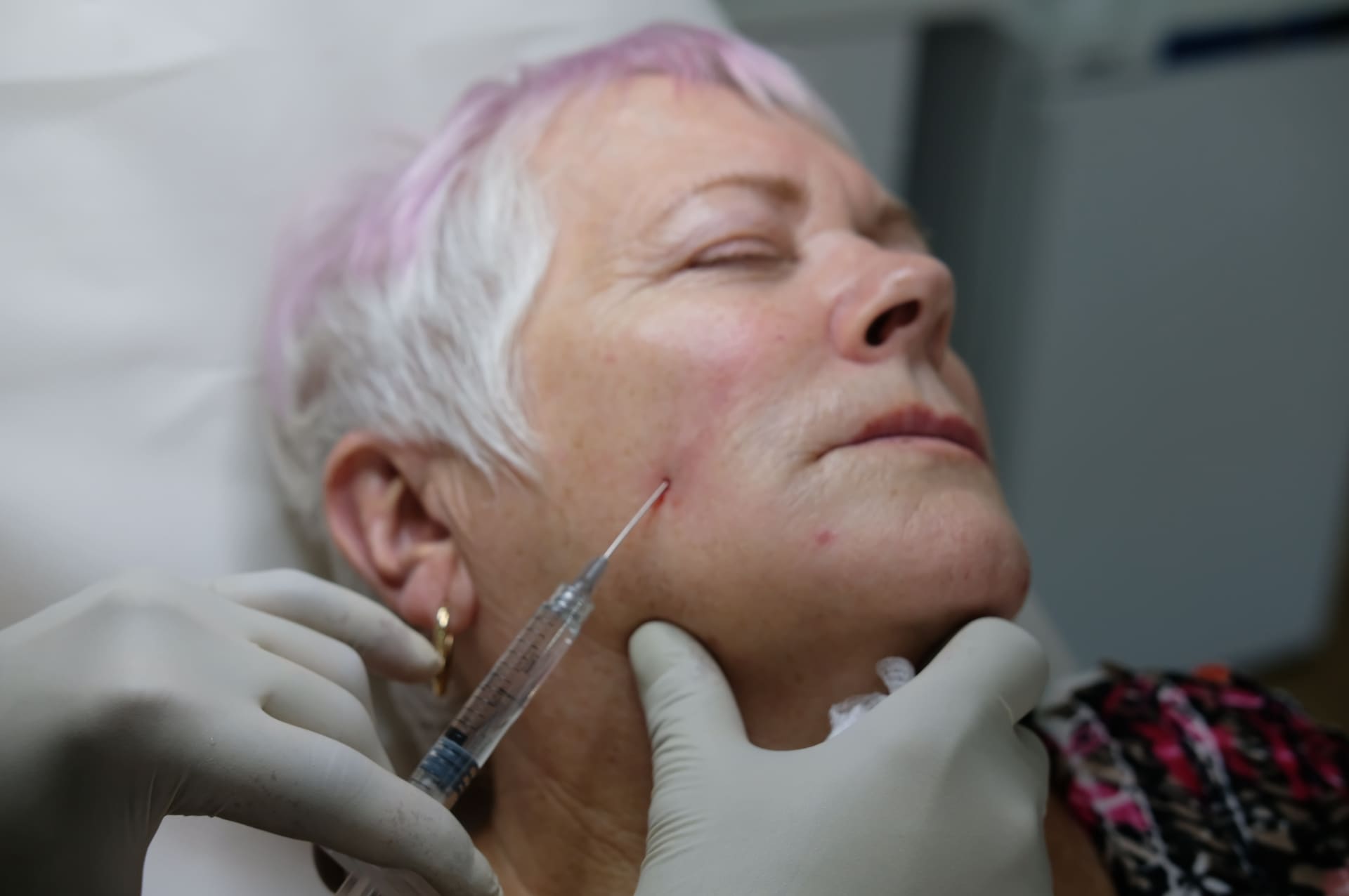 Dr Ahmed Haq aesthetic treatment technique step 3