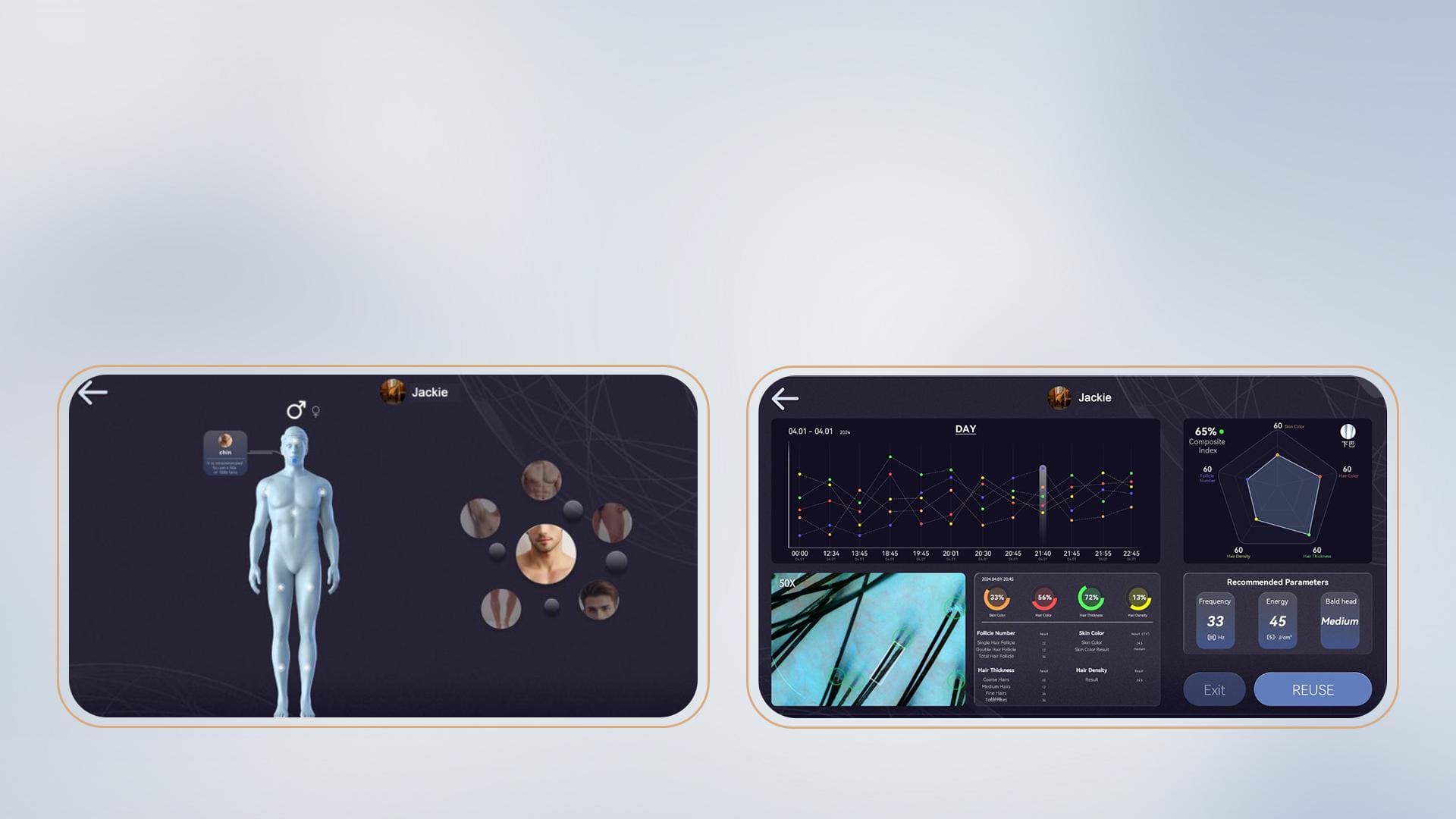 Zephyra AI hair analysis system showing skin colour assessment, hair thickness, and follicle density analysis