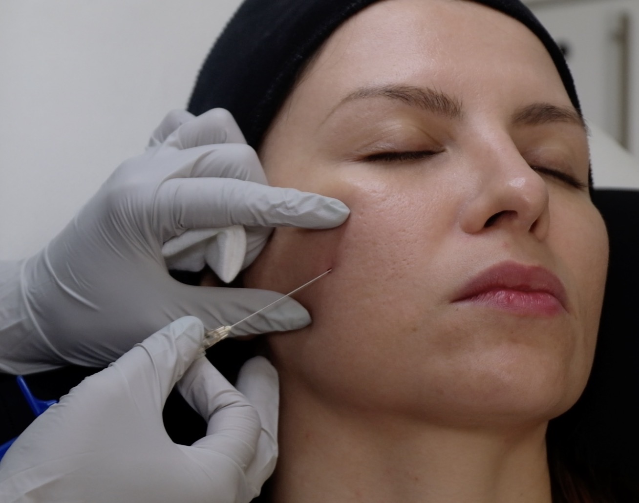 Anterior Cheek Projection
