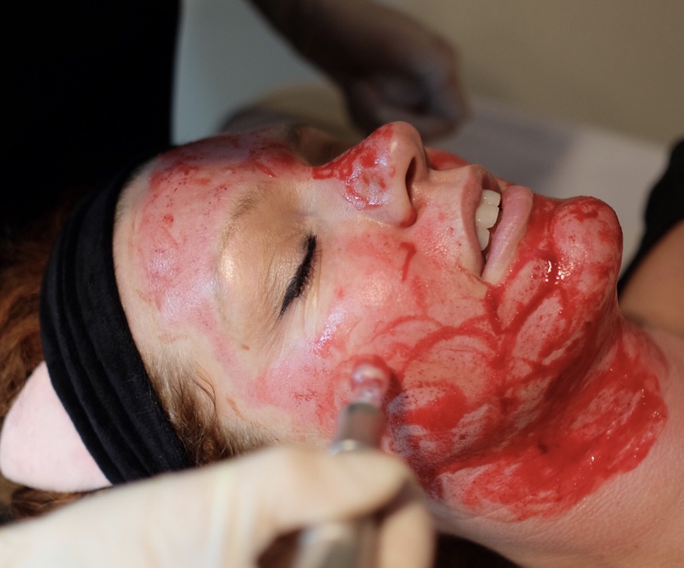 Professional microneedling technique with enhanced serum absorption for collagen induction therapy