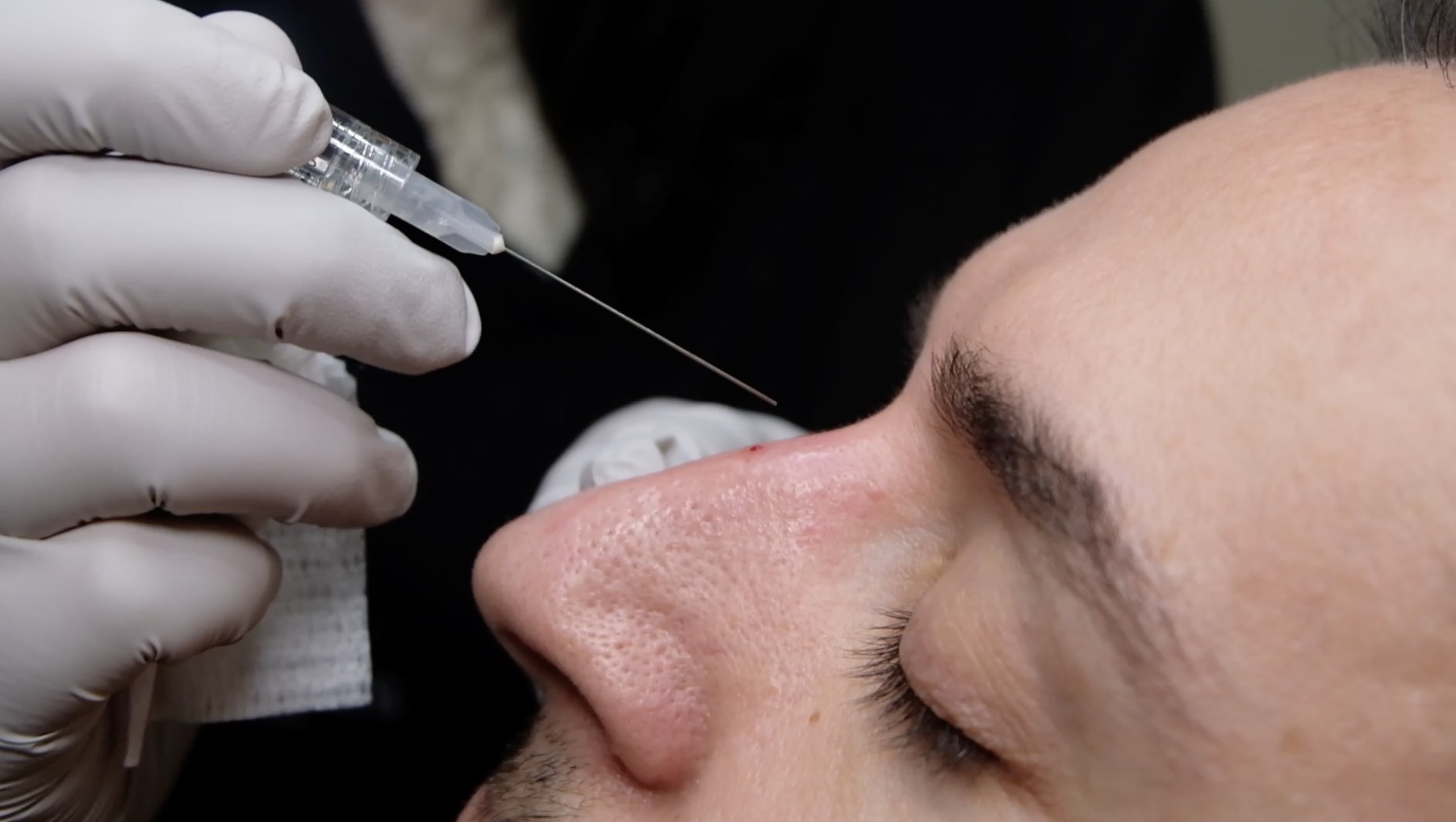 Non-Surgical Rhinoplasty Training for Medical Professionals Non-surgical nose job treatment procedure demonstration for medical professionals