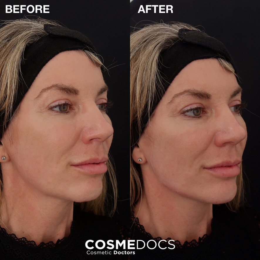 Non-surgical facelift before and after results showing comprehensive facial rejuvenation