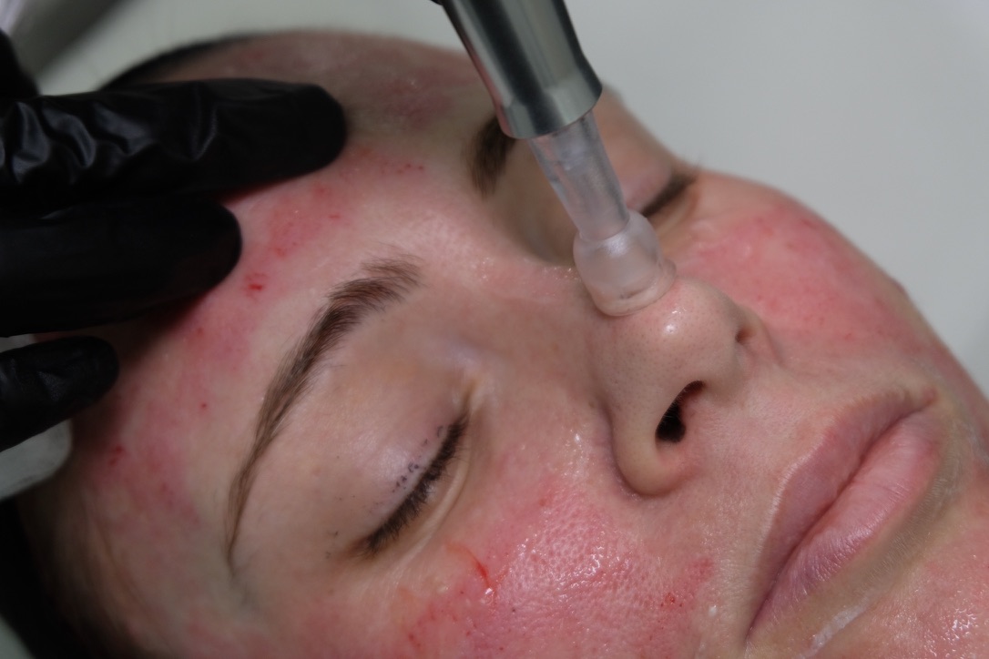 Microneedling collagen induction therapy training at Harley Street Institute