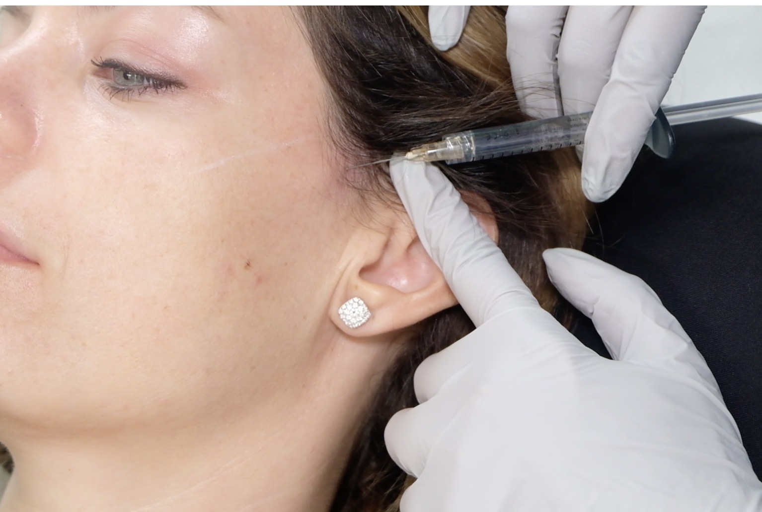Medial Cheek Volumization
