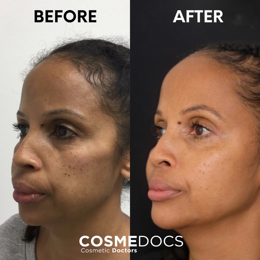 Comprehensive facial rejuvenation before and after results by FACE certified practitioner
